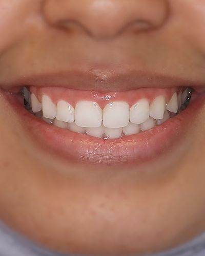 Gingivectomy Smile 1 before